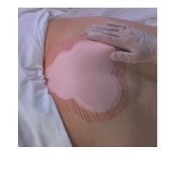 MEDICAZIONE IDROCELLULARE ADESIVA STERILE CONFORMATA PER LA REGIONE SACRALE ASSORBENTE IN SCHIUMA DI POLIURETANO ALLEVYN SACRUM 22,5X22,1CM 10PZ - Farmapre